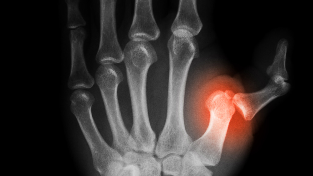 X-ray of dislocated thumb