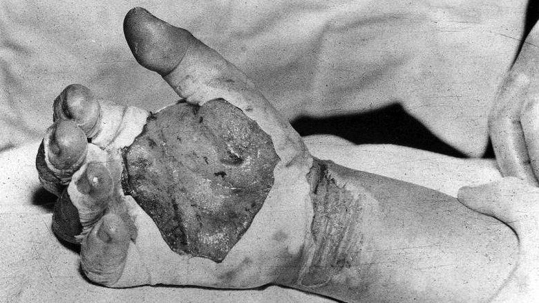 henry daghlian's blistered hand