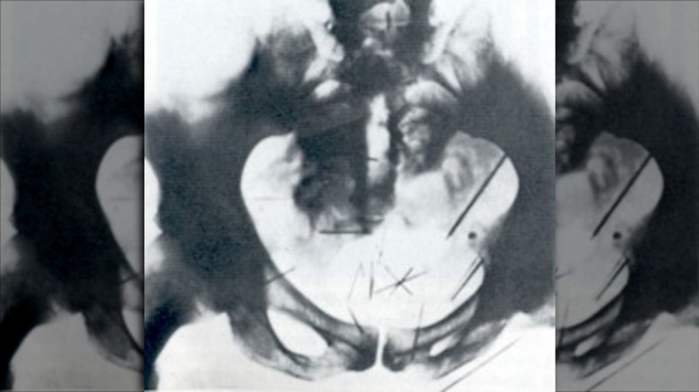 Albert Fish pelvis X-ray needles
