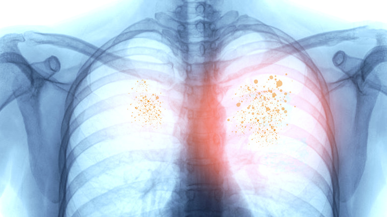 X-ray image of human lungs