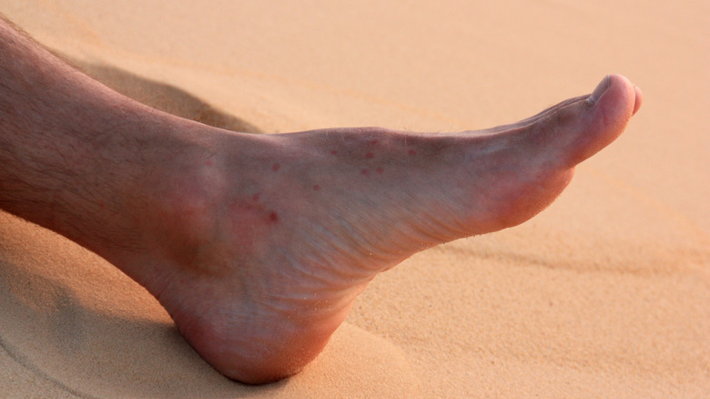 sand flea bites foot