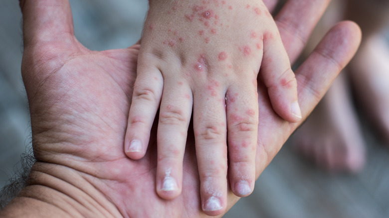 hand foot and mouth disease