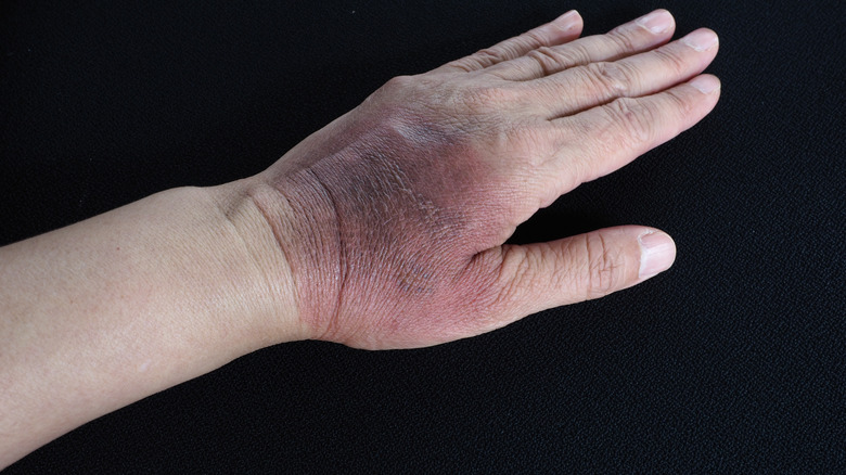Human hand with a burn mark 