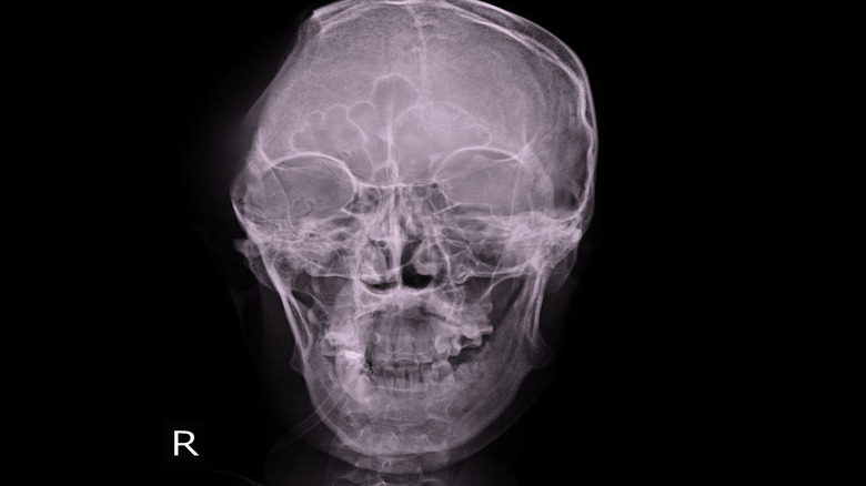 Xray of cranium