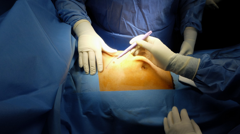 Doctors performing abdominal surgery