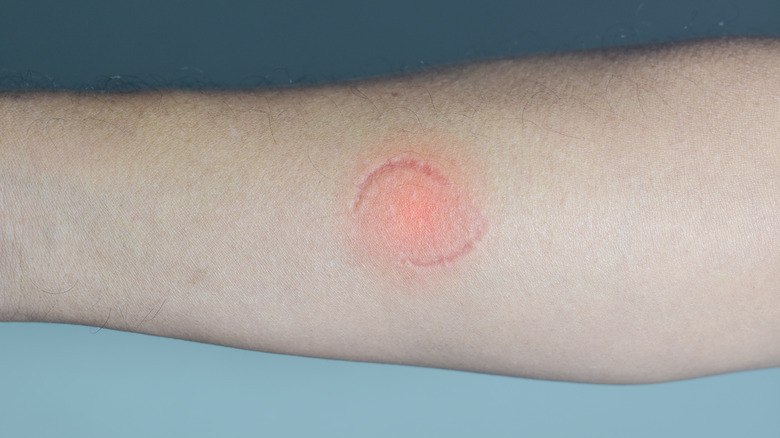 Bite marks on human arm