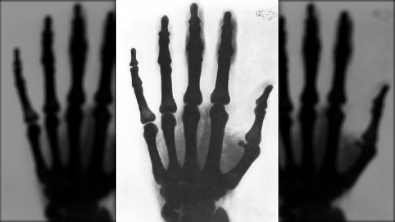 X-ray of Nikola Tesla's hand